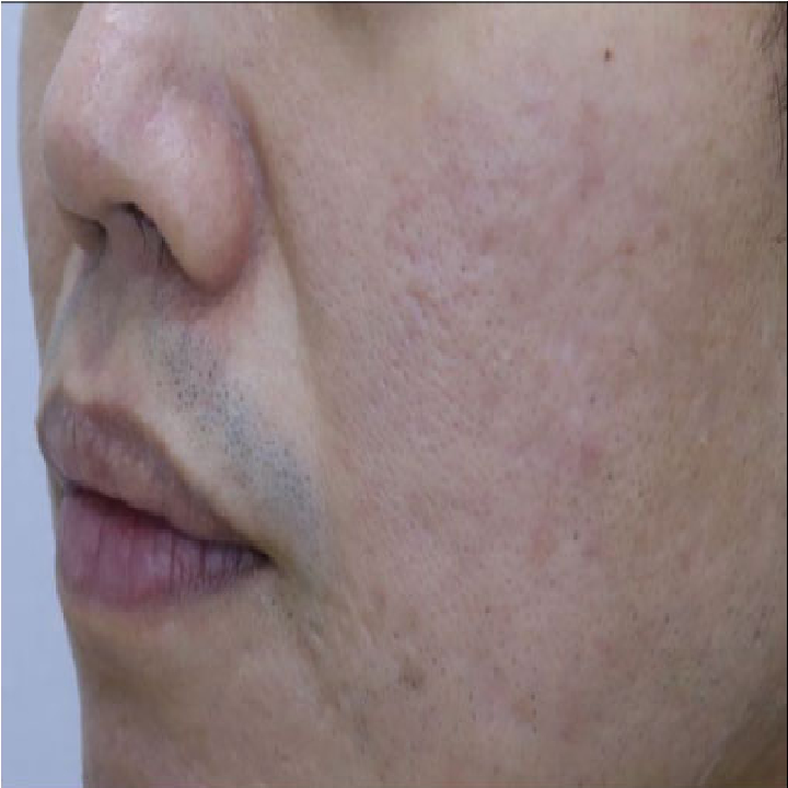 acne scar after