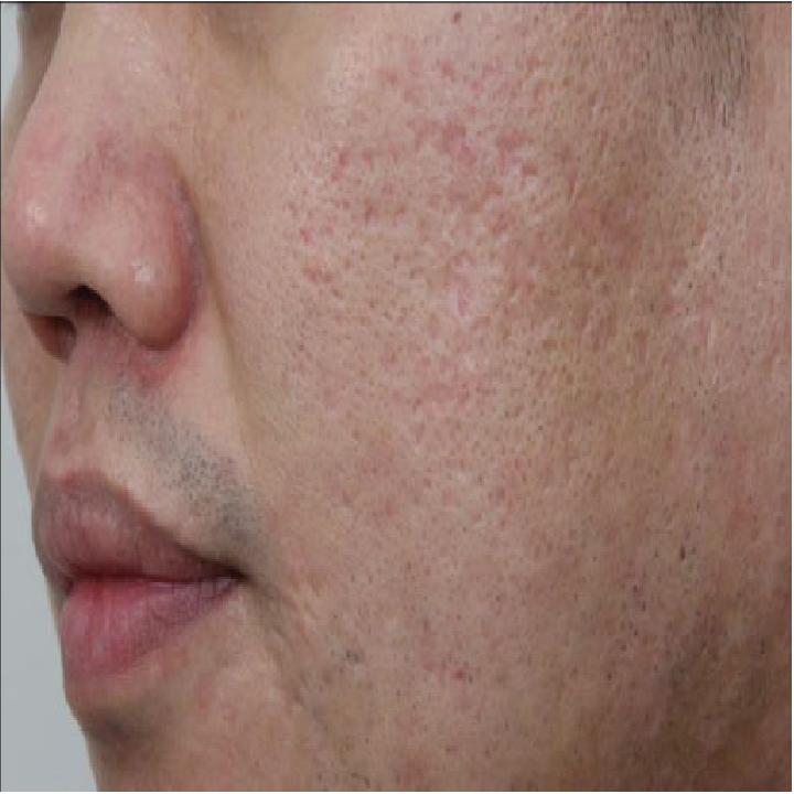 acne scar before